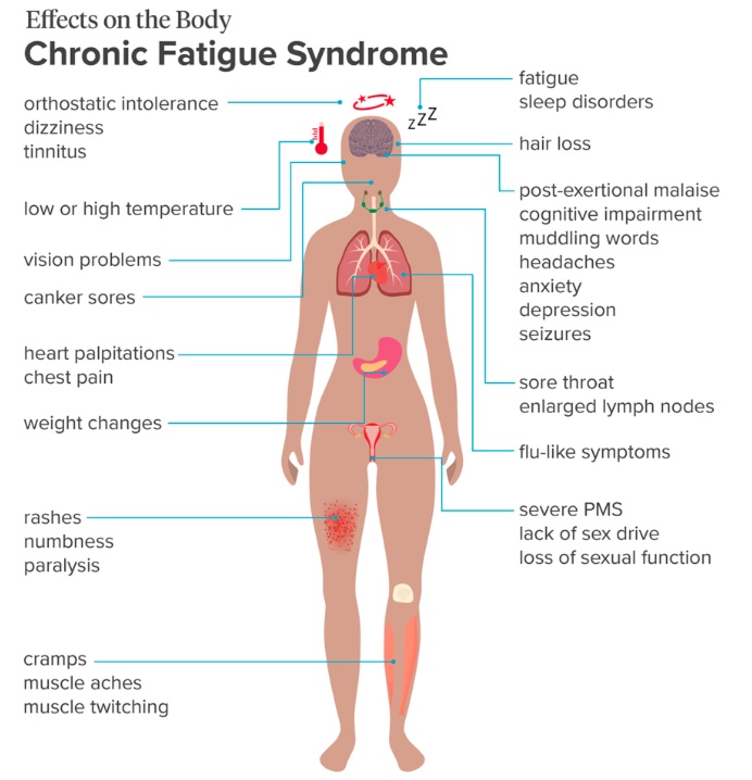 what is Chronic Fatigue Syndrome,Chronic Fatigue Syndrome, CFS
